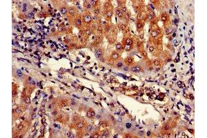 Immunohistochemistry of paraffin-embedded human liver cancer using ABIN7167943 at dilution of 1:100 (ARHGAP25 antibody  (AA 17-280))