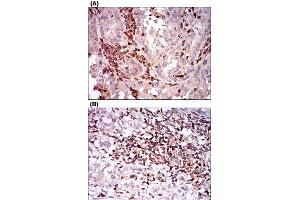 Immunohistochemical staining of human endometrial cancer tissues (A) and bladder cancer tissues (B) with CTNNBL1 monoclonal antibody, clone 1E4F5  at 1:200-1:1000 dilution. (CD68 antibody  (AA 42-155))