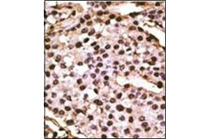 Formalin-fixed and paraffin-embedded human cancer tissue reacted with Autophagy ATG9A Antibody (C-term) followed which was peroxidase-conjugated to the secondary antibody, followed by DAB staining. (ATG9A antibody  (C-Term))