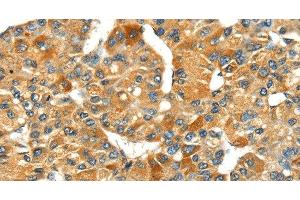 Immunohistochemistry of paraffin-embedded Human liver cancer using SPARC Polyclonal Antibody at dilution of 1:35 (SPARC antibody)