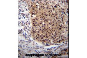 EXTL3 Antibody (N-term) (ABIN656662 and ABIN2845903) immunohistochemistry analysis in formalin fixed and paraffin embedded human esophageal carcinoma followed by peroxidase conjugation of the secondary antibody and DAB staining. (EXTL3 antibody  (N-Term))