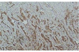 Immunohistochemistry of paraffin-embedded Human breast carcinoma tissue using HDAC1 Monoclonal Antibody at dilution of 1:200. (HDAC1 antibody)