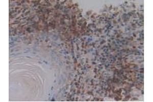 IHC-P analysis of Human Skin Cancer Tissue, with DAB staining. (NPY antibody  (AA 30-97))