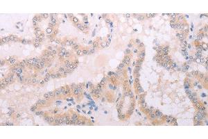 Immunohistochemistry of paraffin-embedded Human thyroid cancer tissue using TPO Polyclonal Antibody at dilution 1:50 (TPO antibody)