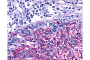 Anti-ADRB3 antibody IHC of human Ovary, Carcinoma. (ADRB3 antibody  (N-Term))