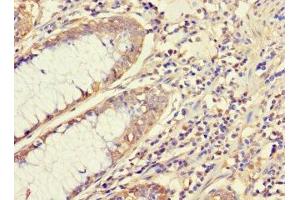 Immunohistochemistry of paraffin-embedded human colon cancer using ABIN7145091 at dilution of 1:100 (ATG5 antibody  (AA 5-272))