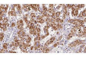 ABIN6278496 at 1/100 staining Human liver cancer tissue by IHC-P. (GRIN2C antibody  (Internal Region))