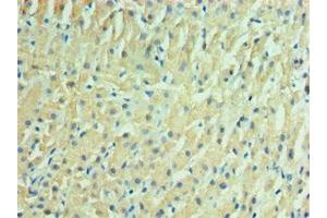 Immunohistochemistry of paraffin-embedded human liver cancer using ABIN7157125 at dilution of 1:100 (IDH2 antibody  (AA 193-452))