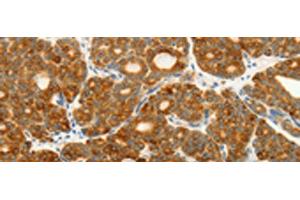 Immunohistochemistry of paraffin-embedded Human thyroid cancer tissue using VEGFB Polyclonal Antibody at dilution of 1:25(x200) (VEGFB antibody)
