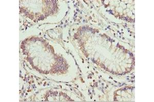 Immunohistochemistry of paraffin-embedded human colon cancer using ABIN7151499 at dilution of 1:100 (ETFA antibody  (AA 1-333))