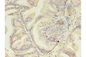 Immunohistochemistry of paraffin-embedded human prostate cancer using ABIN7176718 at dilution of 1:100 (AZGP1 antibody  (AA 61-210))