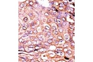 Formalin-fixed and paraffin-embedded human cancer tissue reacted with the primary antibody, which was peroxidase-conjugated to the secondary antibody, followed by AEC staining. (p300 antibody  (pSer89))