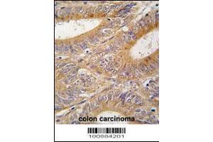 Formalin-fixed and paraffin-embedded human colon carcinoma tissue reacted with AIK antibody , which was peroxidase-conjugated to the secondary antibody, followed by DAB staining. (Aurora A antibody  (N-Term))