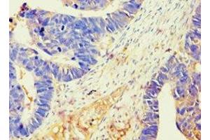 Immunohistochemistry of paraffin-embedded human ovarian cancer using ABIN7145213 at dilution of 1:100 (BAG2 antibody  (AA 1-211))
