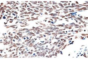 Immunohistochemistry of paraffin-embedded Human lung cancer using AQR Polyclonal Antibody at dilution of 1:100 (40x lens).