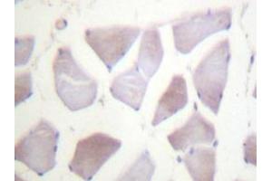 Immunohistochemistry analyzes of PP1α (G315) antibody in paraffin-embedded human breast carcinoma tissue. (CRYAB antibody)
