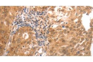 Immunohistochemistry of paraffin-embedded Human ovarian cancer tissue using MMP27 Polyclonal Antibody at dilution 1:50