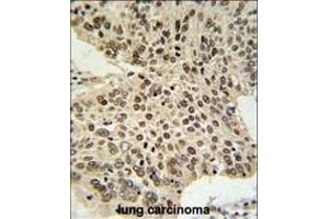 HIST1H2AL Antibody (C-term) (ABIN651090 and ABIN2840066) IHC analysis in formalin fixed and paraffin embedded human lung carcinoma followed by peroxidase conjugation of the secondary antibody and DAB staining.
