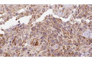 ABIN6273127 at 1/100 staining Human Melanoma tissue by IHC-P.