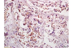 Formalin-fixed and paraffin embedded human gastric cancer labeled with Anti-PPP4C Polyclonal Antibody, Unconjugated (ABIN669261) at 1:200 followed by conjugation to the secondary antibody and DAB staining (PPP4C antibody  (AA 265-307))