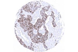 Merkel cell carcinoma with moderate to strong TdT immunostaining in _80 of tumor cells. (Recombinant TdT antibody)