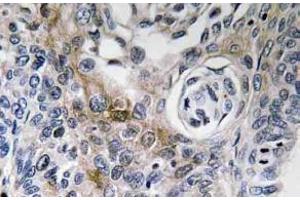 Immunohistochemistry analysis of CD63 antibody in Paraffin-Embedded Human lung carcinoma tissue. (CD63 antibody)