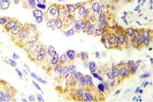 Immunohistochemistry (IHC) analyzes of Tsc2 antibody in paraffin-embedded human lung carcinoma tissue. (Tuberin antibody)