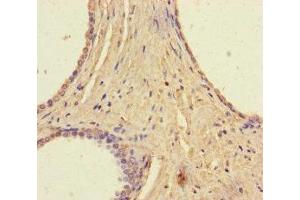 Immunohistochemistry of paraffin-embedded human prostate cancer using ABIN7168135 at dilution of 1:100 (RAVER2 antibody  (AA 2-691))