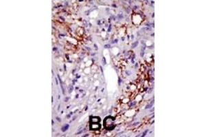 Formalin-fixed and paraffin-embedded human cancer tissue reacted with the primary antibody, which was peroxidase-conjugated to the secondary antibody, followed by DAB staining. (USP22 antibody  (C-Term))