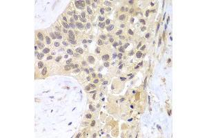 Immunohistochemistry of paraffin-embedded human lung cancer using PSMC5 antibody at dilution of 1:100 (400x lens). (PSMC5 antibody)