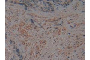 Detection of CRN in Human Prostate Tissue using Polyclonal Antibody to Corin (CRN) (Corin antibody  (AA 134-573))