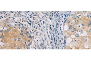 Immunohistochemistry of paraffin-embedded Human breast cancer tissue using GBA Polyclonal Antibody at dilution of 1:55(x200) (GBA antibody)