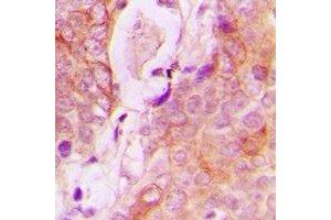Immunohistochemical analysis of RAB34 staining in human breast cancer formalin fixed paraffin embedded tissue section.