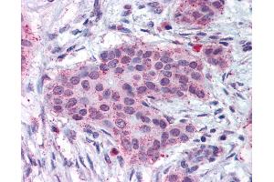 Anti-MMP13 antibody IHC of human breast carcinoma. (MMP13 antibody  (N-Term))