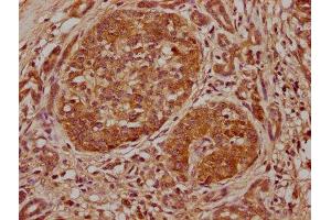 IHC image of ABIN7152094 diluted at 1:500 and staining in paraffin-embedded human pancreatic cancer performed on a Leica BondTM system. (ELF3 antibody  (AA 147-371))