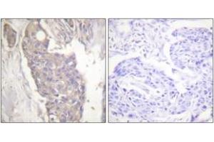 Immunohistochemistry analysis of paraffin-embedded human breast carcinoma tissue, using FAS Antibody.