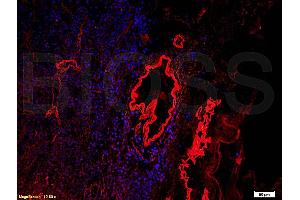 Formalin-fixed and paraffin embedded human esophageal cancer labeled with Anti-Collagen IV Polyclonal Antibody, Unconjugated (ABIN707396) at 1:200, followed by conjugation to the secondary antibody and DAB staining (Collagen IV antibody  (AA 1571-1669))