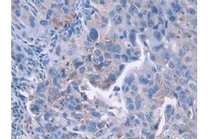 Detection of CDK2 in Human Breast cancer Tissue using Polyclonal Antibody to Cyclin Dependent Kinase 2 (CDK2) (CDK2 antibody  (AA 94-198))