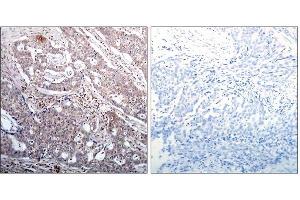 Immunohistochemical analysis of paraffin-embedded human breast carcinoma tissue, using IκB-β (Phospho-Ser23) antibody (E011304). (NFKBIB antibody  (pSer23))