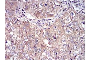 Immunohistochemical analysis of paraffin-embedded lung cancer tissues using RPS6KA2 mouse mAb with DAB staining.