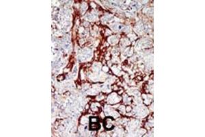 Formalin-fixed and paraffin-embedded human cancer tissue reacted with the primary antibody, which was peroxidase-conjugated to the secondary antibody, followed by DAB staining. (CDKL1 antibody  (C-Term))