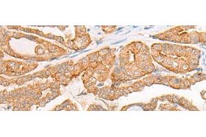 Immunohistochemistry of paraffin-embedded Human thyroid cancer tissue using CYB5D1 Polyclonal Antibody at dilution of 1:45(x200)