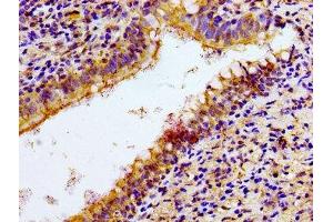 Immunohistochemistry of paraffin-embedded human lung cancer using ABIN7161080 at dilution of 1:100