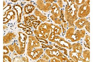 ABIN6260517 and ABIN6277589 at 1/100 staining Human kidney cancer and adjacent normal tissues by IHC-P. (CBR1 antibody  (C-Term))