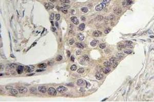 Immunohistochemistry (IHC) analyzes of SLP-76 antibody in paraffin-embedded human breast carcinoma tissue. (LCP2 antibody)