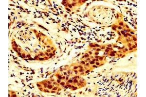 IHC image of ABIN7143973 diluted at 1:300 and staining in paraffin-embedded human bladder cancer performed on a Leica BondTM system. (SCNN1B antibody  (AA 554-640))