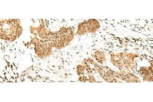 Immunohistochemistry of paraffin-embedded Human esophagus cancer tissue using RBM19 Polyclonal Antibody at dilution of 1:45(x200)