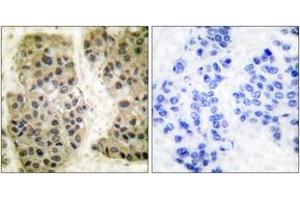 Immunohistochemistry analysis of paraffin-embedded human breast carcinoma tissue, using GANP Antibody.
