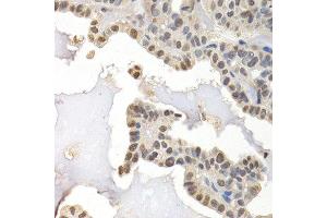 Immunohistochemistry of paraffin-embedded human thyroid cancer using GTF2F1 antibody at dilution of 1:200 (400x lens). (GTF2F1 antibody)