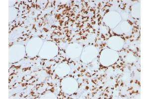Formalin-fixed, paraffin-embedded human Angiosarcoma stained with Histone H1 Mouse Monoclonal Antibody (AE-4) (Histone H1 antibody)